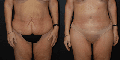 Case 7034 - 52 year old woman treated with Thigh Lift