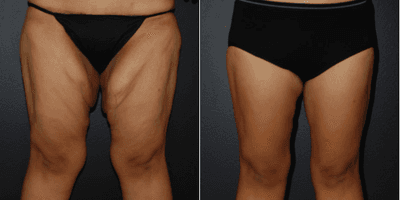 Case 7035 - Woman treated with Thigh Lift