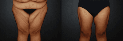 Case 7036 - Woman treated with Thigh Lift