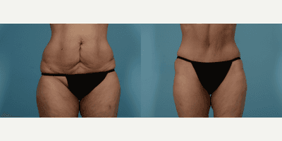 Case 705 - 55-64 year old woman treated with Tummy Tuck
