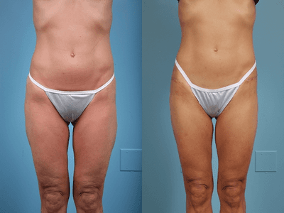 Case 7146 - Thigh Lift Patient