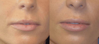 Case 7149 - 25-34 year old woman treated with Lip Implants