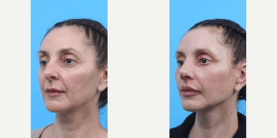 Case 7150 - Woman treated with Eyelid Surgery, Facelift, Neck Lift, Lip Lift, Lip Implants, Rhinoplasty