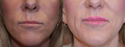 Case 7152 - 50-59 year old woman treated with Lip Implants