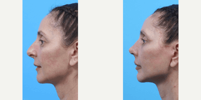 Case 7153 - Woman treated with Eyelid Surgery, Neck Lift, Lip Lift, Lip Implants, Facelift, Rhinoplasty