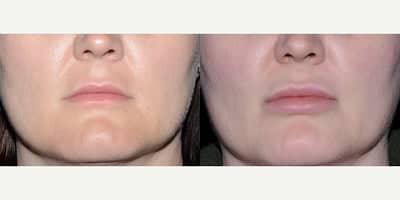 Case 7155 - 32 year old woman treated with Lip Implants.