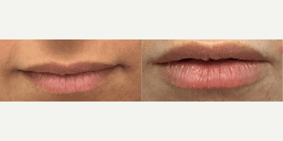 Case 7285 - Woman treated with Lip Fillers