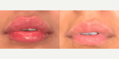 Case 7288 - Woman treated with Lip Fillers, Restylane