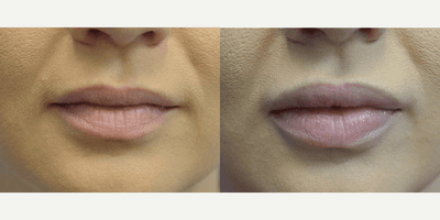 Case 7291 - Woman treated with Juvederm, Lip Fillers