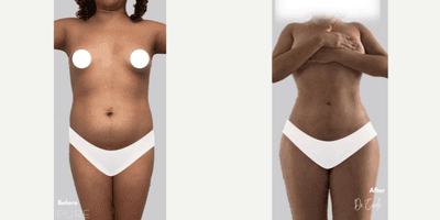 Case 7406 - Woman treated with Brazilian Butt Lift