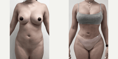 Case 7410 - Woman treated with Brazilian Butt Lift