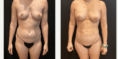 Case 7411 - 35-44 year old woman treated with Abdominal Etching, Brazilian Butt Lift, Breast Fat Transfer