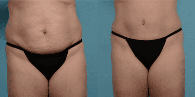 Case 742 - 45-54 year old woman treated with Tummy Tuck