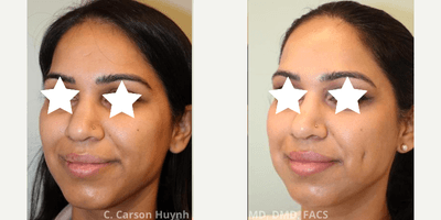 Case 7526 - 25-34 year old woman treated with Dimple Surgery