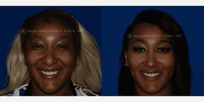 Case 7527 - Dimpleplasty