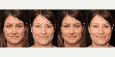 Case 7528 - 25-34 year old woman treated with Dimpleplasty