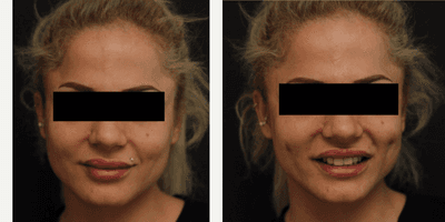 Case 7534 - 25-34 year old woman treated with Dimpleplasty