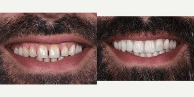 Case 7582 - 35-44 year old man treated with Porcelain Veneers, Lumineers, Smile Makeover, Zoom Whitening