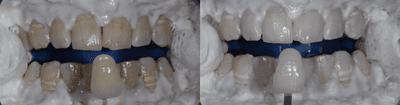 Case 7587 - 18-24 year old man treated with Zoom Whitening