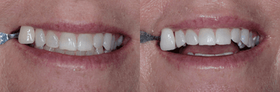 Case 7590 - ZOOM! In-Office Whitening Treatment