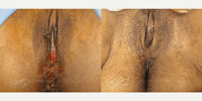 Case 7678 - 53 year old woman treated with Vaginoplasty