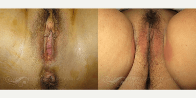 Case 7679 - 36 year old woman treated with Vaginoplasty