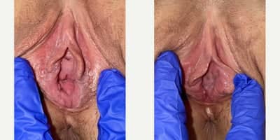 Case 7765 - 25-34 year old woman treated with Vaginoplasty, Perineoplasty