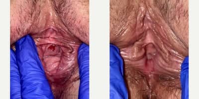 Case 7766 - 25-34 year old woman treated with Vaginoplasty, Perineoplasty