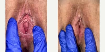 Case 7767 - 55-64 year old woman treated with Vaginoplasty, Perineoplasty