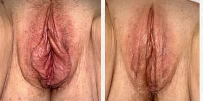 Case 7768 - 45-54 year old woman treated with Labiaplasty, Clitoral Hood Reduction, Vaginoplasty, Perineoplasty