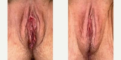 Case 7769 - 35-44 year old woman treated with Vaginoplasty, Perineoplasty