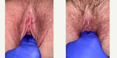 Case 7772 - 65-74 year old woman treated with Vaginoplasty, Labiaplasty, Clitoral Hood Reduction