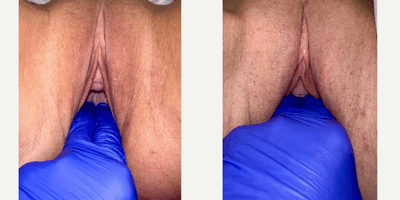 Case 7787 - 35-44 year old woman treated with Vaginoplasty, Perineoplasty