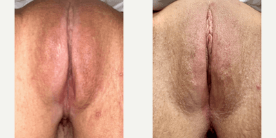 Case 7788 - 35-44 year old woman treated with Vaginoplasty, Perineoplasty