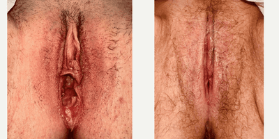 Case 7789 - 45-54 year old woman treated with Vaginoplasty, Perineoplasty
