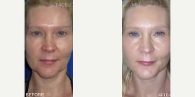 Case 7791 - Woman treated with Facelift, CO2 Laser, Eyelid Surgery