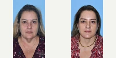Case 7793 - Woman treated with Facelift