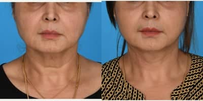 Case 7794 - 55-64 year old woman treated with Facelift, Mini Facelift, SMAS Facelift, Lower Facelift, Neck Lift, Deep Plane Facelift
