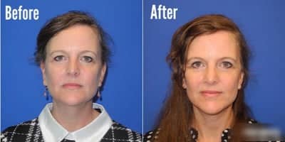 Case 7795 - Woman treated with Facelift