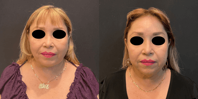 Case 7827 - 55-64 year old woman treated with Facelift