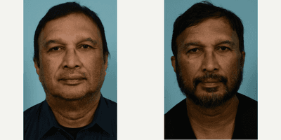 Case 7833 - Man treated with Facelift, Neck Lift