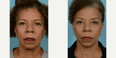 Case 7835 - Woman treated with Facelift, Neck Lift