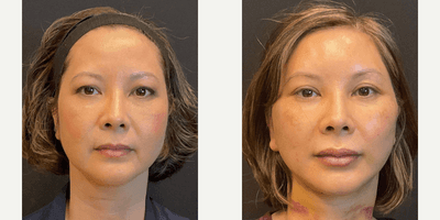 Case 7838 - Deep plane facelift, deep plane neck lift, and upper lid blepharoplasty seen at one week