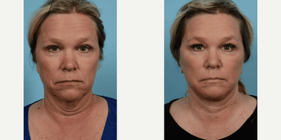 Case 7843 - Woman treated with Facelift, Neck Lift