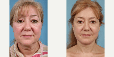 Case 7855 - 55 year old woman treated with Facelift, Neck Lift