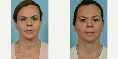 Case 7873 - Woman treated with Facelift, Neck Lift