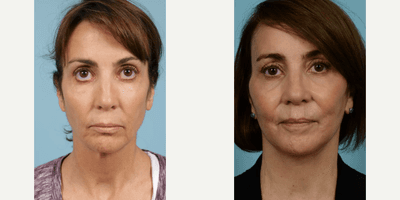 Case 7908 - Woman treated with Facelift, Neck Lift