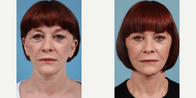 Case 7909 - Woman treated with Facelift, Neck Lift