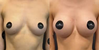 Case 7918 - Woman treated with Breast Augmentation, Breast Implants