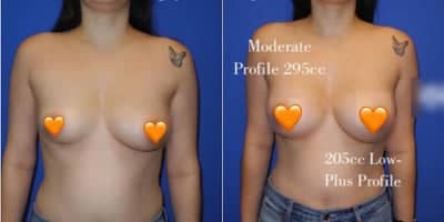 Case 7919 - Woman treated with Breast Augmentation, Breast Implants
